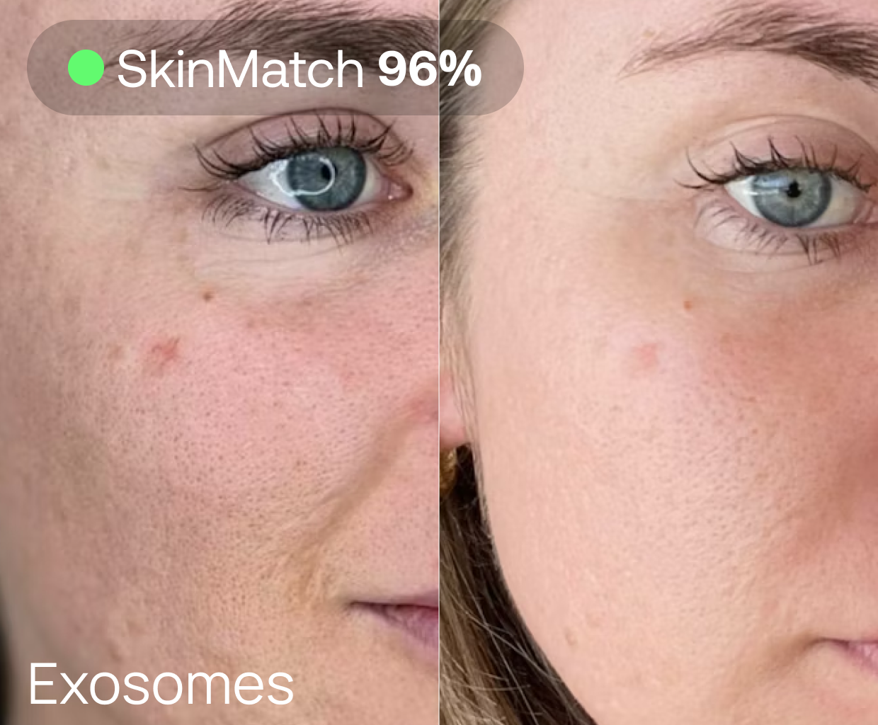 Partial view of a before and after comparison showing skin improvement, possibly in pigmentation or texture, with a result attributed to exosomes treatment.