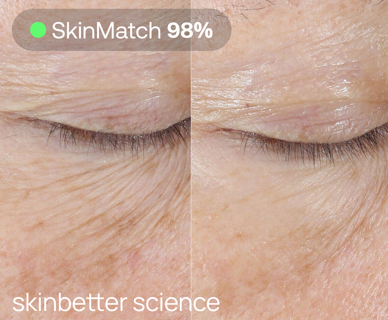 Before and after results demonstrating significant reduction in fine lines and wrinkles around the eye, with animprovement from Skinbetter Science Interfused Eye Cream.